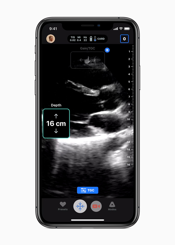An ultrasound scan from Butterfly IQ displayed on iPhone XS.